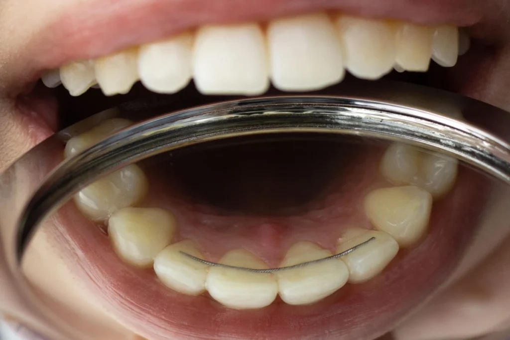 orthodontie gisors contention fil fixe Orthodontie adulte Dr Luca MANGIARACINA - Orthodontie Gisors