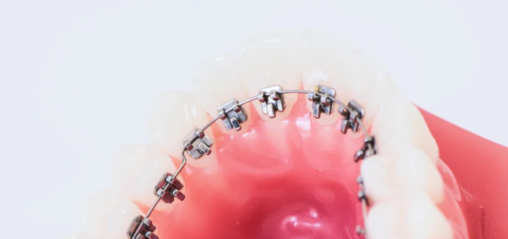 orthodontie linguale gisors Orthodontie adulte Dr Luca MANGIARACINA - Orthodontie Gisors