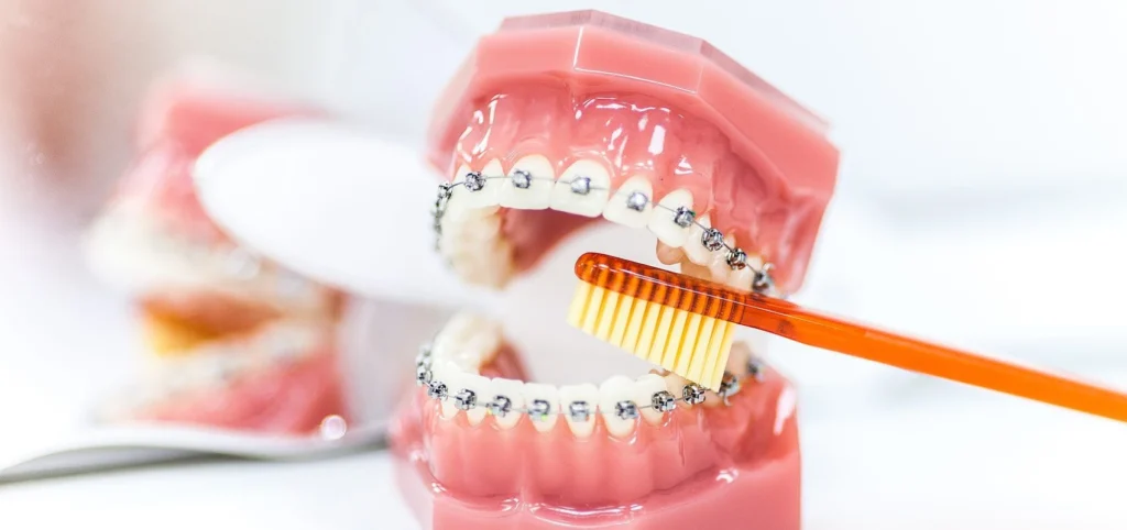 nettoyer dents appareil orthodontie gisors Orthodontie & Hygiène bucco-dentaire Dr Luca MANGIARACINA - Orthodontie Gisors